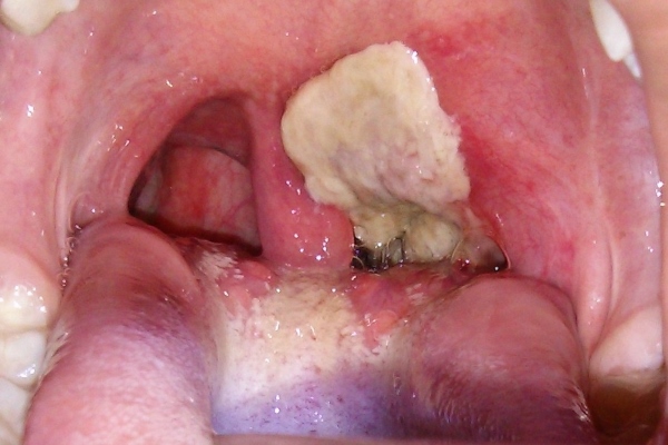 دراسة:استئصال اللوزتين في مرحلة الطفولة يزيد من خطر الإصابة بالعدوى في وقت لاحق