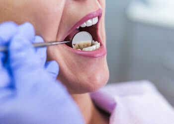 هل هناك علاقة بين بكتيريا الفم والأمراض المهددة للحياة؟.. دراسة توضح ذلك