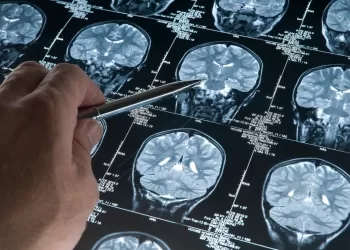 دراسة تحذر من مخاطر أدوية الأرق وتسببها في الإصابة بـ”الزهايمر”