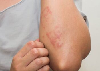 حساسية الشمس.. أعراضها وكيفية مواجهتها