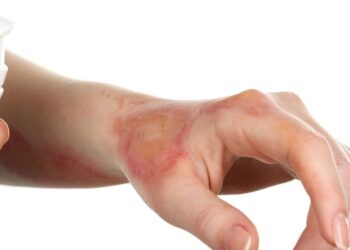 5 علاجات طبيعية لحروق الماء الساخن.. تعرف عليها