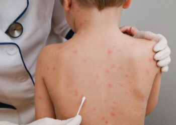 “جدري القردة” يثير قلق العالم وترقب لإعلان حالة طوارئ