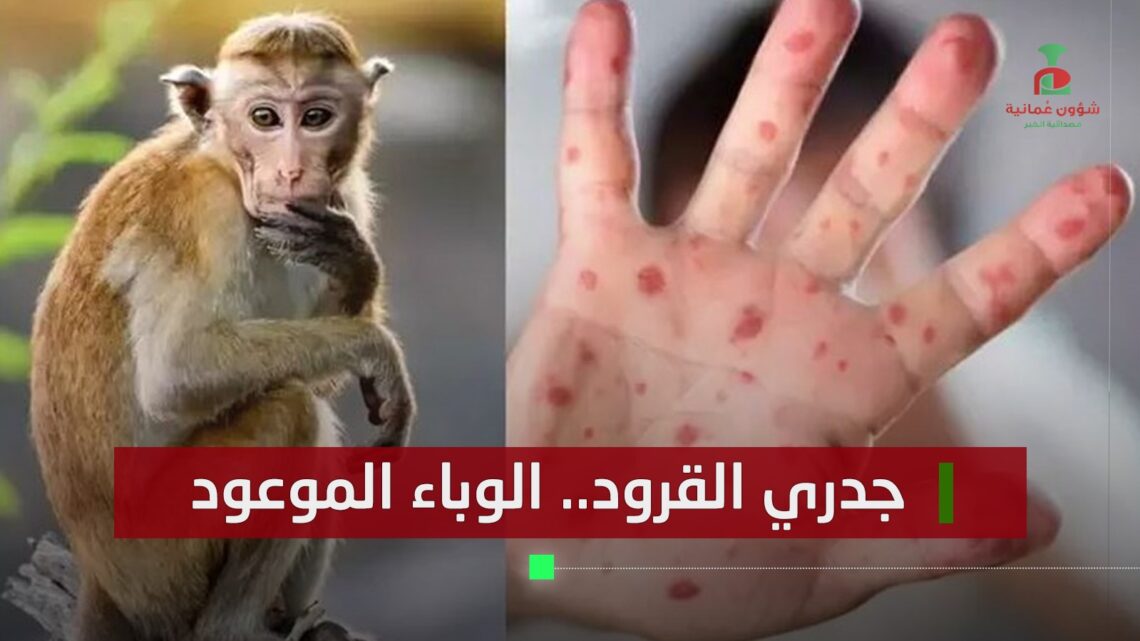 جدري القرود.. الوباء الموعود