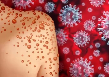 خبراء: تفشي جدري القردة في أفريقيا ناجم عن الإهمال