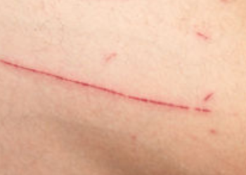 جروح اليد البسيطة قد تنذر بمرض جلدي خطير.. لا تتجاهلها