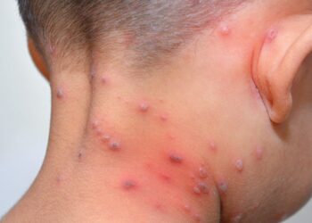 جدري القردة يصل إلى أكبر دولة سكانياً