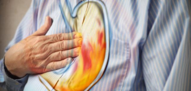 حموضة المعدة المتكررة.. علام تدل؟