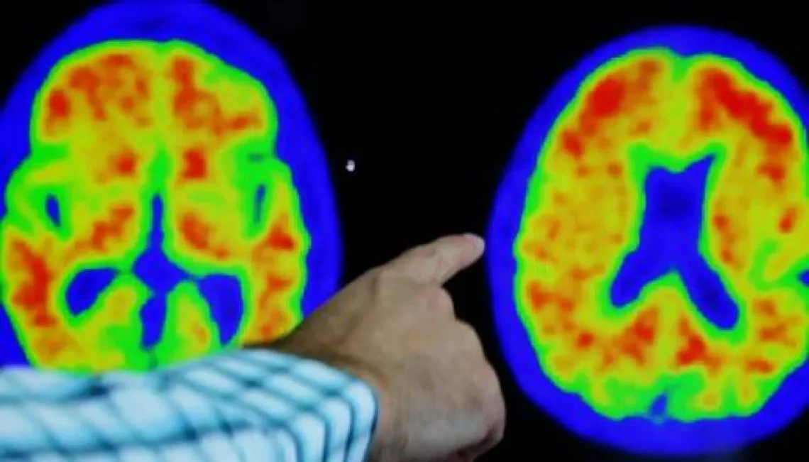 كيف نعرف إذا كنا نعاني من نقص في الدوبامين؟