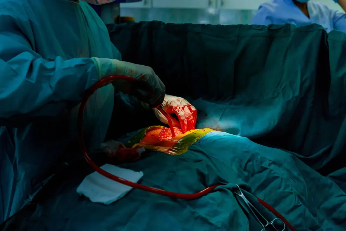 علاج واعد لمرض الكلى في مرحلته النهائية