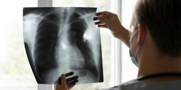 تقنية جديدة ترصد الالتهاب الرئوي عبر تحليل النفس بدقة عالية