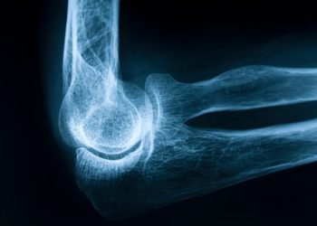 5 طرق سهلة لتقوية عظامك دون الحاجة لتناول مكملات الكالسيوم